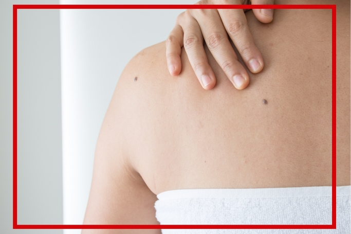 Kiedy badać znamiona – czas na przegląd skóry po lecie
