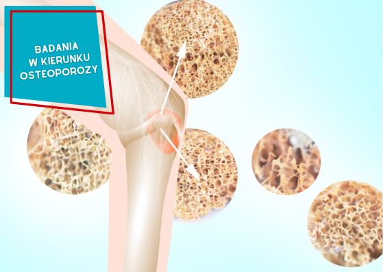 Diagnostyka osteoporozy – badania densytometryczne w Przychodniach Brackich
